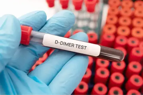 Ręka w niebieskiej rękawiczce trzyma probówkę z napisem "D-DIMER TEST". W tle widać rząd czerwonych probówek. Badanie d-dimery a stan zapalny.