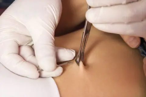 En piercare med vita handskar använder en klämma och nål för att utföra en achilles piercing.