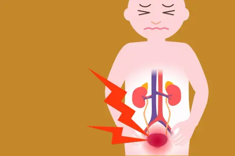 Personne souffrant de douleurs à la vessie hyperactive, avec des éclairs rouges symbolisant la douleur. Avis sur Urostim 2.