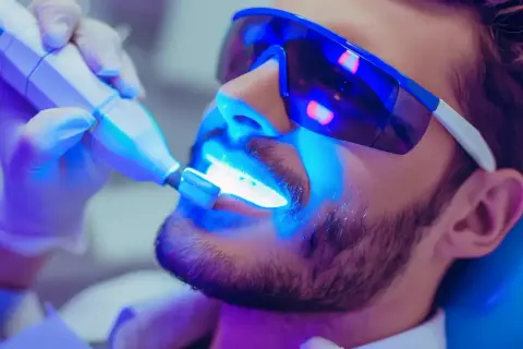 Mężczyzna w okularach ochronnych przechodzi wybielanie zębów u dentysty. Niebieskie światło lampy aktywuje żel wybielający.