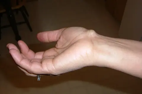 Polso con cisti sinoviale, in cerca di una pomata efficace per alleviare il disturbo.