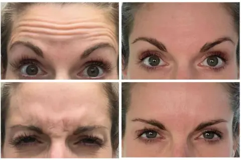 Vier close-ups van een voorhoofd met rimpels, die de effecten van botox tonen. Sommigen beweren dat botox slecht voor hersenen kan zijn.