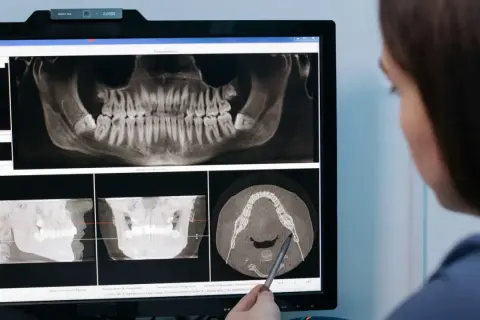 Dentysta analizuje zdjęcia RTG szczęki, planując powtórne leczenie kanałowe.