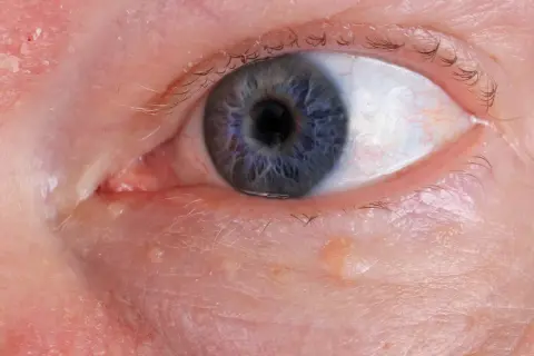 Nahaufnahme eines blauen Auges mit kleinen Bläschen am Lidrand, die auf **Herpes am Auge** hindeuten könnten.