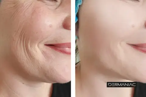 Antes y después de un tratamiento para suavizar las líneas de marioneta y rejuvenecer la piel.