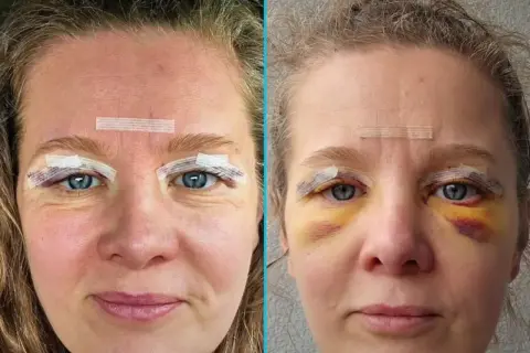 Przed i po zabiegu blefaroplastyki NFZ. Widoczne opuchlizny i siniaki wokół oczu po operacji.