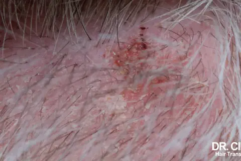 Gros plan sur un cuir chevelu sec et irrité, avec des squames et des rougeurs, suggérant une perte de cheveux.