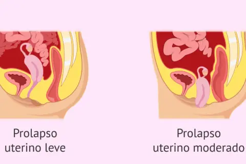 Ilustración comparativa de prolapso uterino leve y moderado, mostrando la posición del útero y órganos pélvicos.