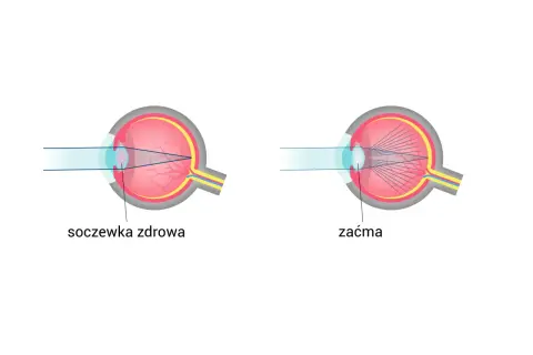 Schemat oka z soczewką zdrową i zaćmą. Promienie światła skupiają się inaczej, wpływając na widzenie. Spojówka jest częścią oka.