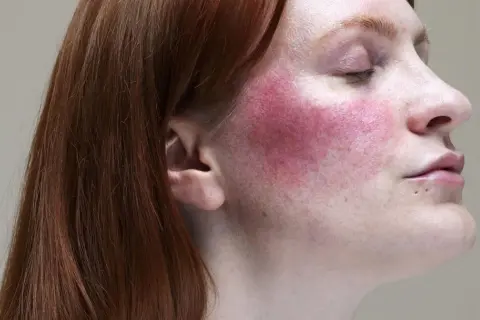 Rötliche Wangen bei Rosacea, ausgelöst durch Alkohol.