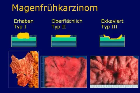 Magenkarzinom-Typen: Erhaben (Typ I), Oberflächlich (Typ II) und Exkaviert (Typ III). Bilder zeigen verschiedene Stadien eines pt2 tumor.
