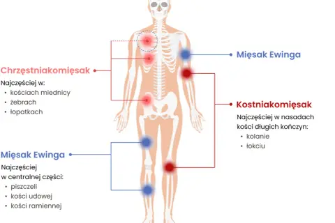 Schemat pokazuje lokalizację mięsaków kości: chrzęstniakomięsaka (czerwone punkty) w miednicy, żebrach, łopatkach; kostniakomięsaka (czerwone punkty) w nasadach kości długich; mięsaka Ewinga (niebieskie punkty) w piszczeli, kościach udowej i ramiennej.