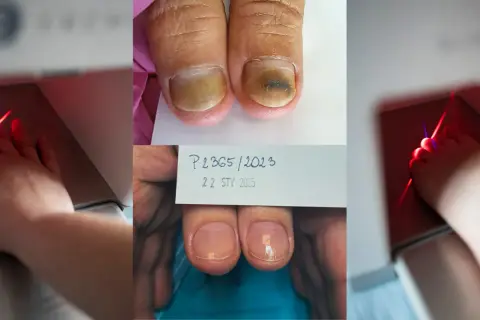Grzybica paznokci: Od lakieru po laser co wyleczy ją na stałe?