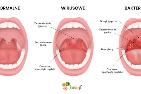 Porównanie gardła: normalne, wirusowe (zaczerwienienie, obrzęk języczka) i bakteryjne (białe plamy, bostonka w gardle).