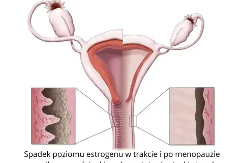 Spadek estrogenu powoduje suchość pochwy objawy: ścieńczenie i wysuszenie ścianek. Ilustracja pokazuje zmiany w narządach rodnych.