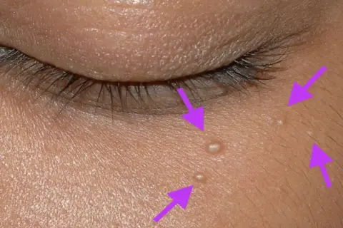 Flèches violettes pointant vers de petits points blancs sur la peau, indiquant un grain de milium près de l'œil.