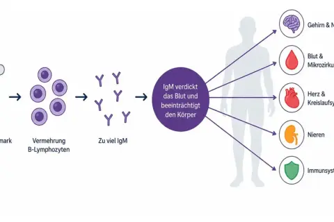 Knochenmark vermehrt B-Lymphozyten, was zu viel IgM führt. Dies verdickt das Blut und beeinträchtigt Gehirn, Herz, Nieren und Immunsystem, was auf MGUS-Beschwerden hindeutet.