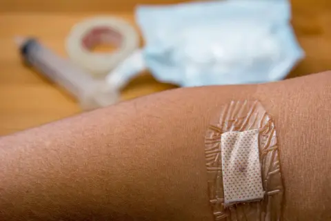 Plaster na skórze, pod nim widoczna drobna ziarnina. W tle strzykawka i taśma medyczna.