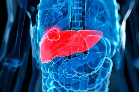 Abbildung einer menschlichen Leber mit einem roten Tumor. Die Darstellung zeigt, wohin Leberkrebs streut, indem sie die Ausbreitung im Körper visualisiert.