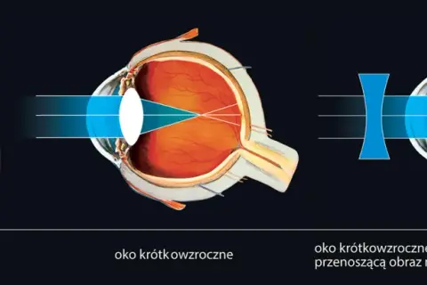 Krótkowzroczność: Jakie soczewki wybrać? Poradnik dla Ciebie