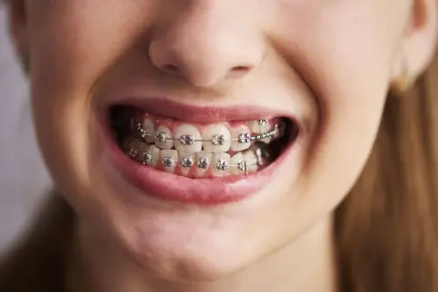 Sorriso di una persona con apparecchio denti. I denti sono allineati con brackets metallici e fili.