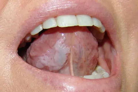 Lingua con aree bianche indicative di leucoplachia, potenziale segno precoce di tumore alla lingua.