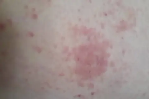Éruption cutanée rosée sur la peau, possiblement liée à un staphylocoque doré combien de temps après opération.