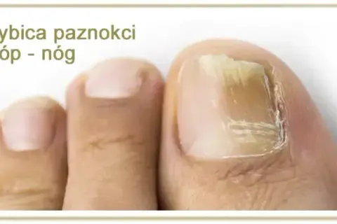 Jak skutecznie zapobiec grzybicy – praktyczne porady i sprawdzone metody