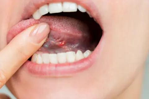 Otwarta usta z widocznym zapaleniem języka, gdzie palec wskazuje na zaczerwienione, opuchnięte miejsce z małą krostką.