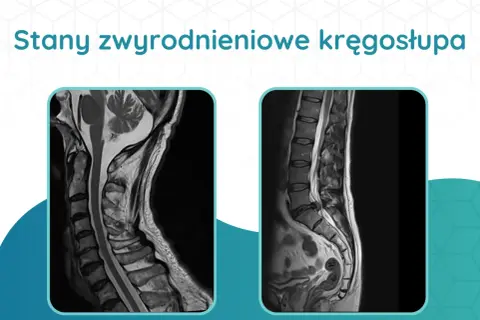 Dwa obrazy rezonansu magnetycznego kręgosłupa: szyjnego i lędźwiowego, ukazujące stany zwyrodnieniowe. Diagnostyka kręgosłupa jest kluczowa.