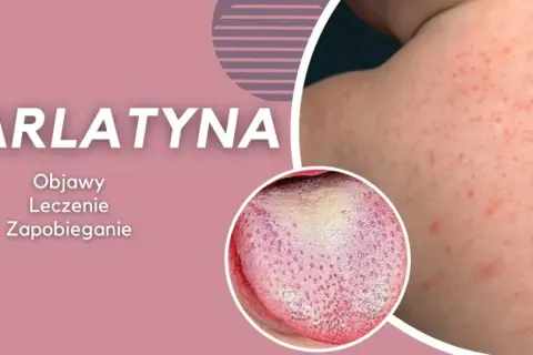 Szkarlatyna u dorosłych: czerwona wysypka na skórze i nalot na języku. Informacje o objawach, leczeniu i zapobieganiu.