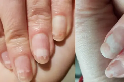 Onycholiza po hybrydzie. Paznokcie odspajają się od płytki, tworząc białe plamy.