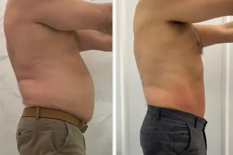 Liposukcja: Modelowanie sylwetki czy odchudzanie? Pełny przewodnik