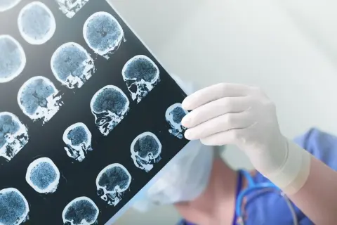 Lekarz w białej rękawiczce analizuje prześwietlenie mózgu, szukając śladów naczyniaka jamistego.
