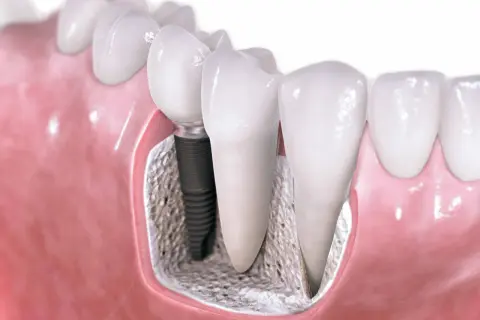 Implant stomatologiczny w kości, obok naturalnego zęba. Sprawdź, jaka jest most na implantach cena.