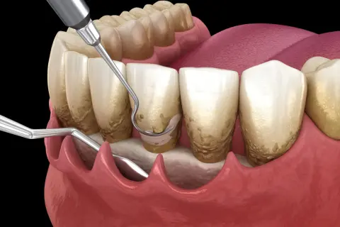 Herramientas dentales eliminan sarro en una limpieza dental profunda. El nombre del procedimiento es crucial para la salud bucal.