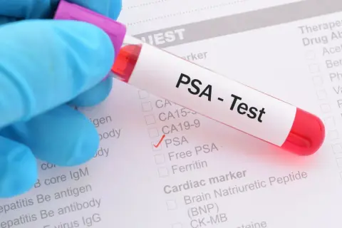 Ręka w niebieskiej rękawiczce trzyma probówkę z napisem "PSA - Test". Zaznaczono pole PSA na liście badań.