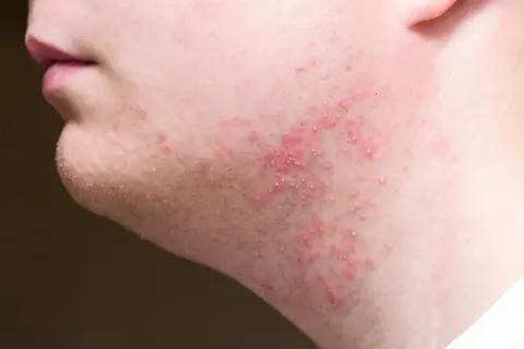 Peau irritée après rasage, avec des rougeurs et de petits boutons sur la joue.