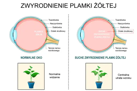 Porównanie przekroju zdrowego oka i oka z suchym zwyrodnieniem plamki żółtej.