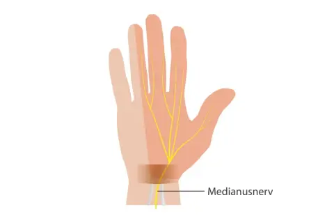 Darstellung des Medianusnervs in der Hand, der bei Karpaltunnelsyndrom-OP entlastet wird.