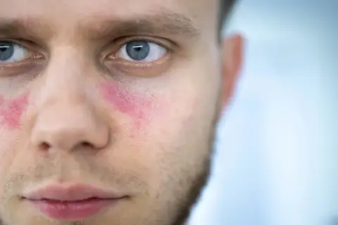Czerwone plamy na policzkach mężczyzny, które mogą być objawem tocznia.