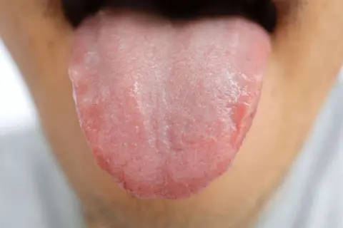 Lingua arrossata e irritata, con piccole vescicole, che suggeriscono un bruciore alla lingua.