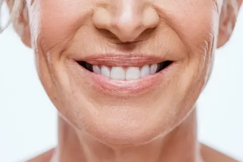 Sonrisa radiante con surco nasogeniano antes y después. Piel tersa y rejuvenecida.