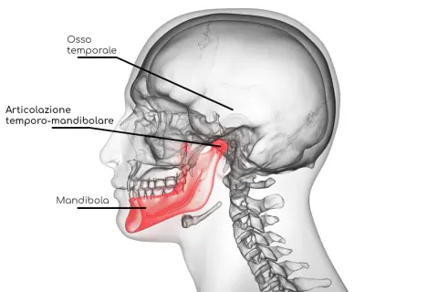 Illustrazione anatomica del cranio che evidenzia l'articolazione temporo-mandibolare, la mandibola (in rosso) e l'osso temporale. Utile per comprendere la disfunzione temporo mandibolare.