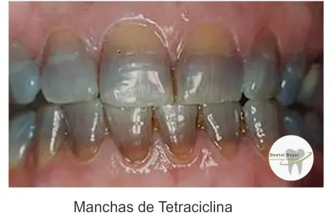 Dientes con manchas verdes y amarillas, indicativo de manchas de tetraciclina.