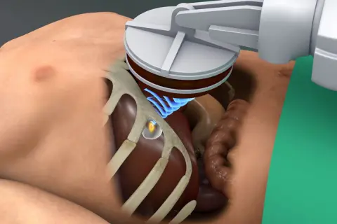 Ultraschallsonde über dem Bauchraum, ein kleiner, gelblicher tumor ultraschall erkennbar. Blaue Wellen zeigen die Schallübertragung.