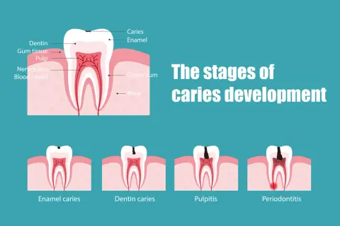 Ilustración muestra las etapas de desarrollo de una caries, desde el esmalte hasta la periodontitis, indicando cuándo empieza a doler una caries.