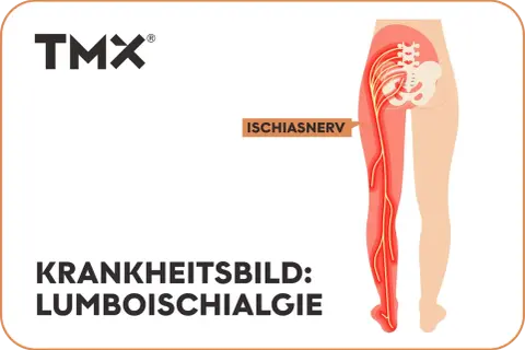 Darstellung des Ischiasnervs, der vom unteren Rücken bis zum Fuß verläuft. Das Krankheitsbild Lumboischialgie links zeigt eine Reizung dieses Nervs.