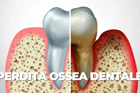 Illustrazione di un dente sano e uno malato, con osso alveolare che mostra riassorbimento osseo alveolare diffuso di tipo orizzontale e verticale.
