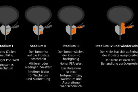 Illustrationen zeigen Stadien von Prostatakrebs, von Stadium I (unauffällig) bis Stadium IV (ausgebreitet), die die Entwicklung eines Adenokarzinoms der Prostata veranschaulichen.